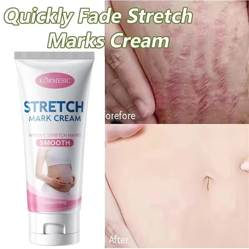 Stretch Marks Permanent Removal Cream Maternity Pregnant Women Pregnancy Anti-Winkle Smooth Repair Firming Skin Body Skin Care