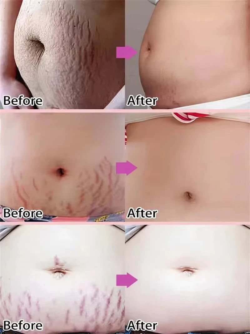 Stretch Marks Permanent Removal Cream Maternity Pregnant Women Pregnancy Anti-Winkle Smooth Repair Firming Skin Body Skin Care