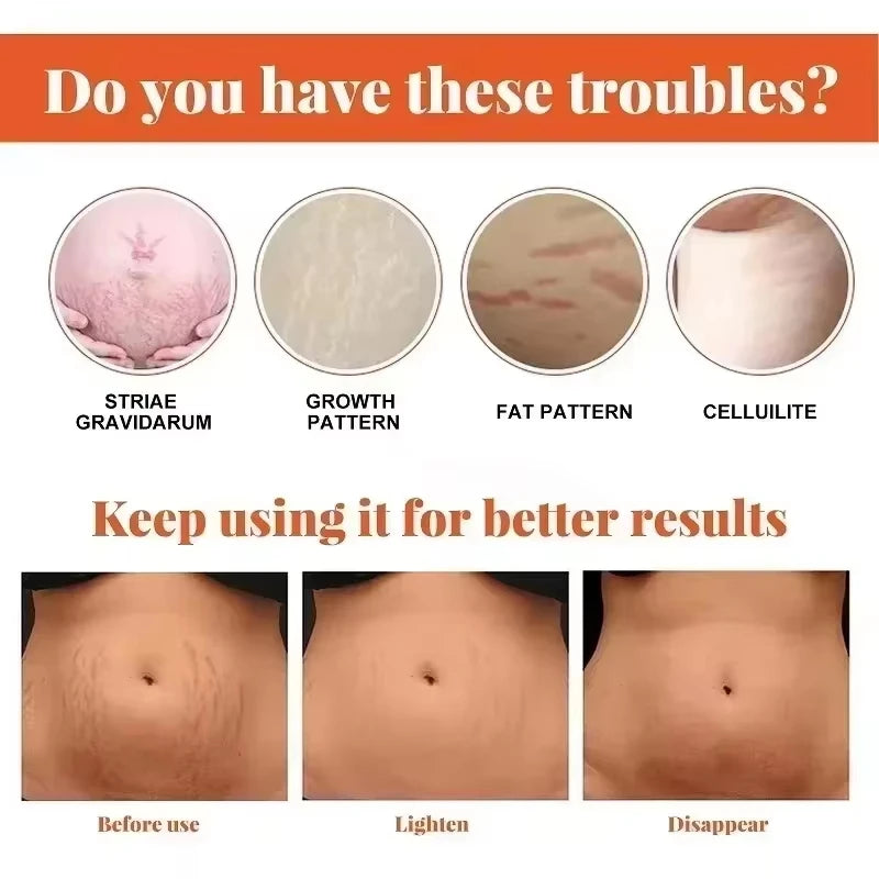 Stretch Marks Permanent Removal Cream Maternity Pregnant Women Pregnancy Anti-Winkle Smooth Repair Firming Skin Body Skin Care