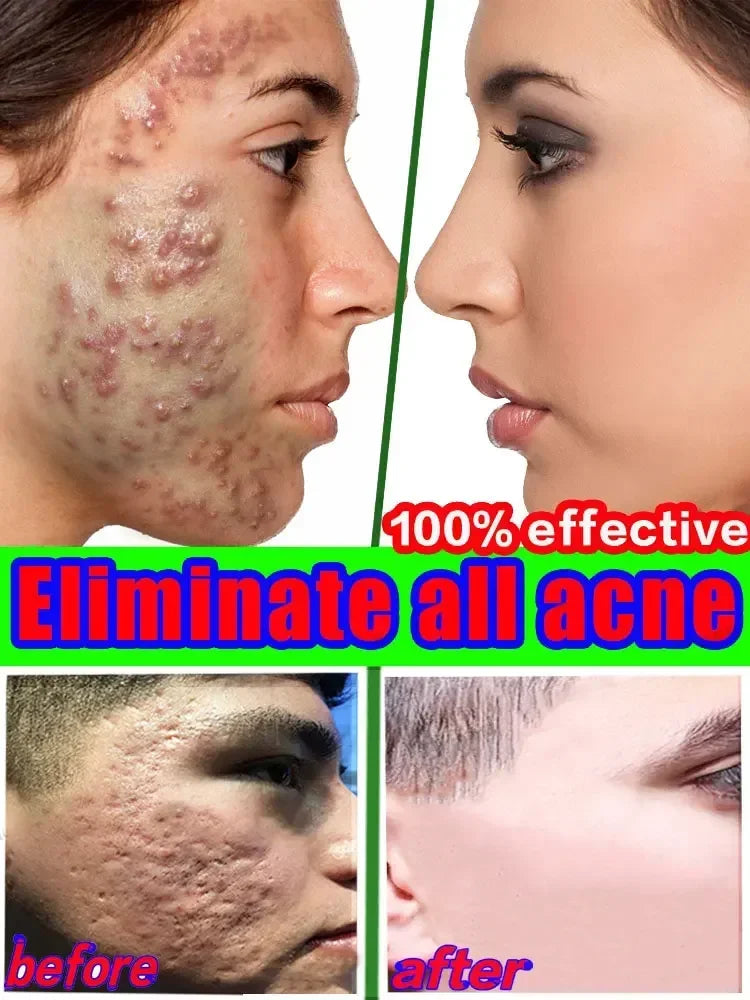 2026 Salicylic Acid  Solution Essence Shrink pores and Acne Spot Removing Shrink Pores Oil-Control Brighten Face Skin Makeup