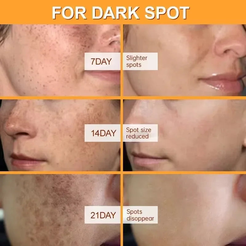 Whitening Freckles Face Cream Removal Melasma Dark Spots Corrector Lighten Melanin Pigmentation Brighten Anti-Aging Beauty Careصحح البقع الداكنة (Dark Spots Corrector): يقلل من مظهر البقع البنية والداكنة وآثار الحبوب.
تقليل صبغة الميلانين (Lighten Melani