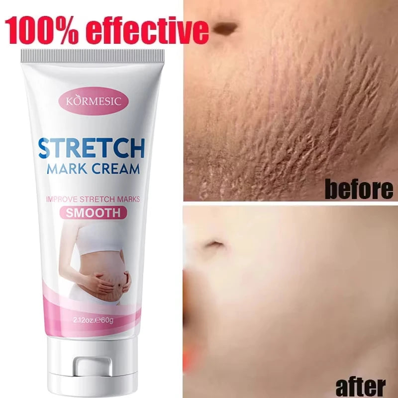 Stretch Marks Permanent Removal Cream Maternity Pregnant Women Pregnancy Anti-Winkle Smooth Repair Firming Skin Body Skin Care