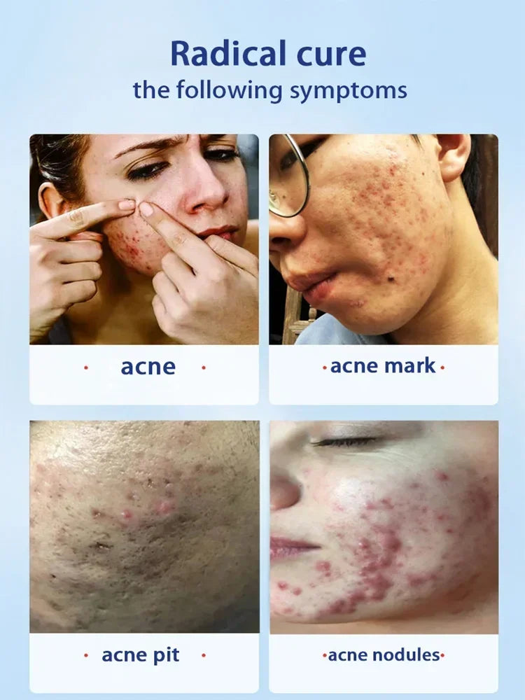 2026 Salicylic Acid  Solution Essence Shrink pores and Acne Spot Removing Shrink Pores Oil-Control Brighten Face Skin Makeup