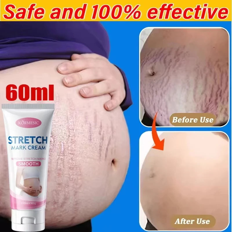 Stretch Marks Permanent Removal Cream Maternity Pregnant Women Pregnancy Anti-Winkle Smooth Repair Firming Skin Body Skin Care